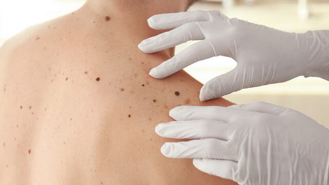 ¿Sabías que el cáncer de piel más agresivo y letal también es el más prevenible? Conoce cómo detectarlo