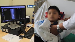 EsSalud: Médicos realizan autotrasplante óseo y salvan brazo a menor de 7 años