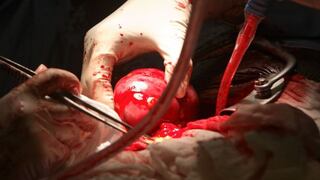 EEUU: Enfermera frustra trasplante al botar riñón sano a la basura