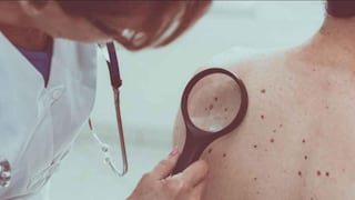 “Por un Perú Sin Cáncer”: la iniciativa para alertar sobre el peligro de la radiación ultravioleta y el cáncer de piel