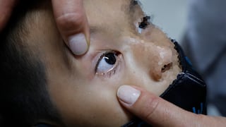 EsSalud: Médicos peruanos salvan ojo de niño que sufrió mordedura de su mascota