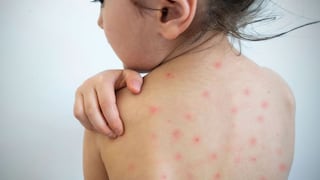 El sarampión nos amenaza: la clave  para prevenir este mal es la vacunación