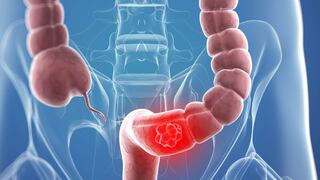 Cáncer de colon: Un mal que se puede prevenir con hábitos de vida saludables
