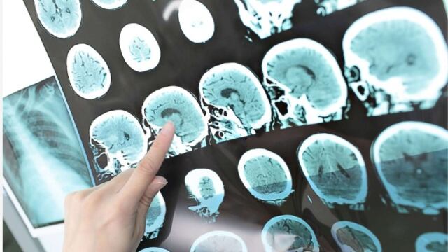 Tumores cerebrales: ¿cómo detectarlos a tiempo y cómo evitarlos?