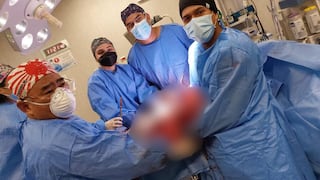 Cirujanos del Hospital PNP extirpan tumor de 35kg y salvan vida a esposa de policía