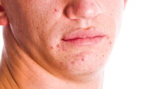 Brote de acné en adultos, posible síntoma de diabetes