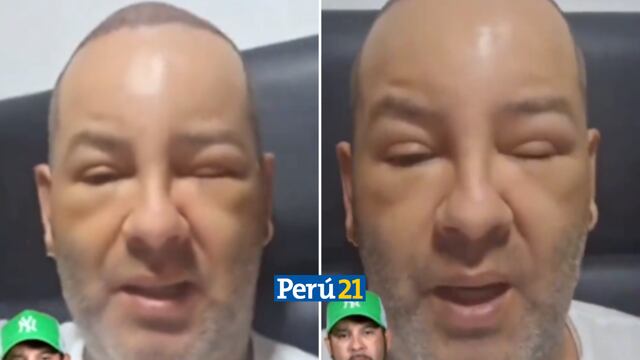 Ricky Trevitazzo impacta al aparecer con el rostro hinchado en redes sociales (VIDEO)