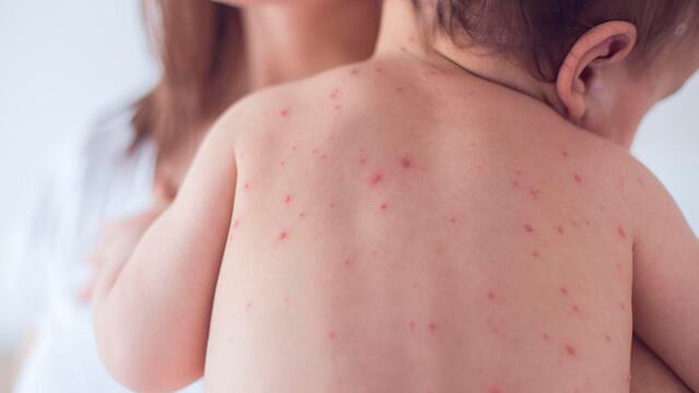 Más de 900 mil niños están desprotegidos ante varicela
