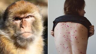 Viruela del mono: Sigue estos protocolos si tienes estos síntomas