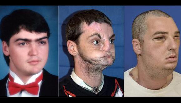 TRANSFORMACIÓN. El antes y después de la operación a la que fue sometido Richard Norris, de 37 años. (Reuters)