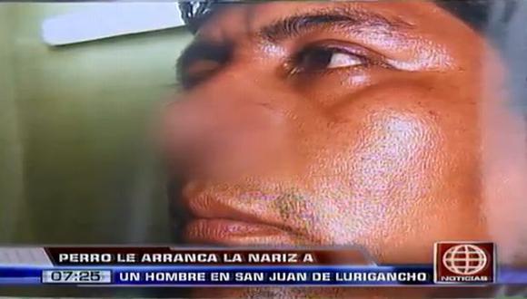 San Juan de Lurigancho: Perro le arrancó la nariz a un hombre. (Captura de TV)