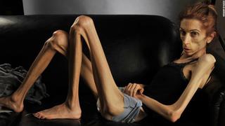 Youtube: Conoce la nueva apariencia de Rachael Farrokh, quien pesaba 18 kilos y que venció a la anorexia