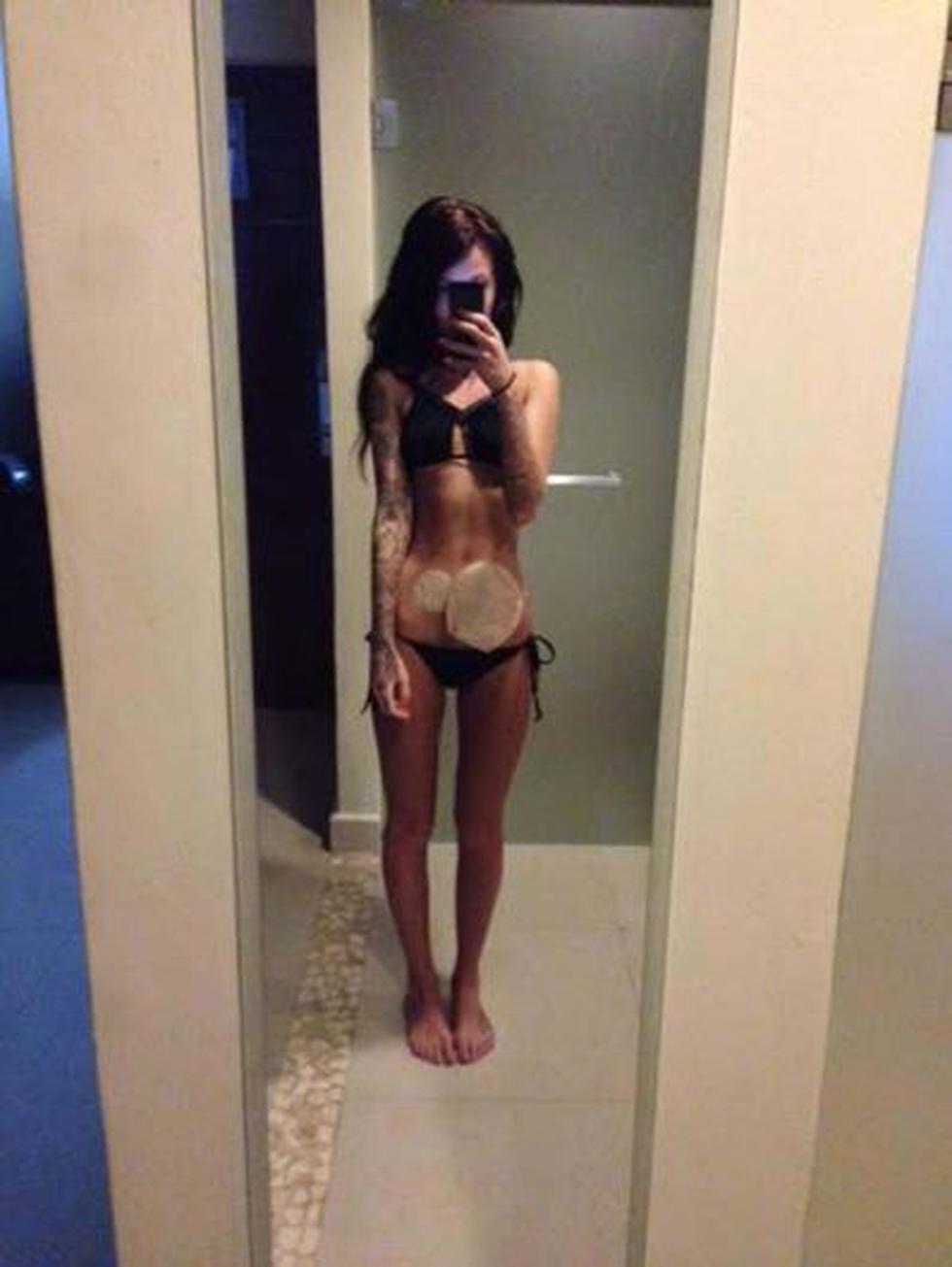 Bethany Townsend, la inglesa en bikini que causa furor por su colostomía, MUNDO