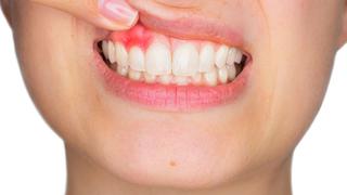 COVID-19: Las personas con periodontitis tienen casi 9 veces más posibilidades de fallecer si se contagian